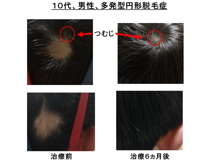 円形脱毛症　病院
